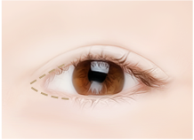 神奇眼角整形手术步骤