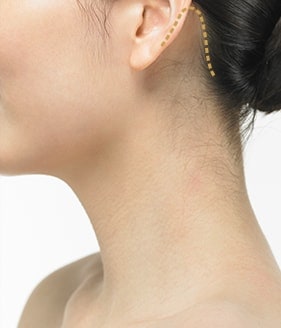 颈部拉皮手术方法