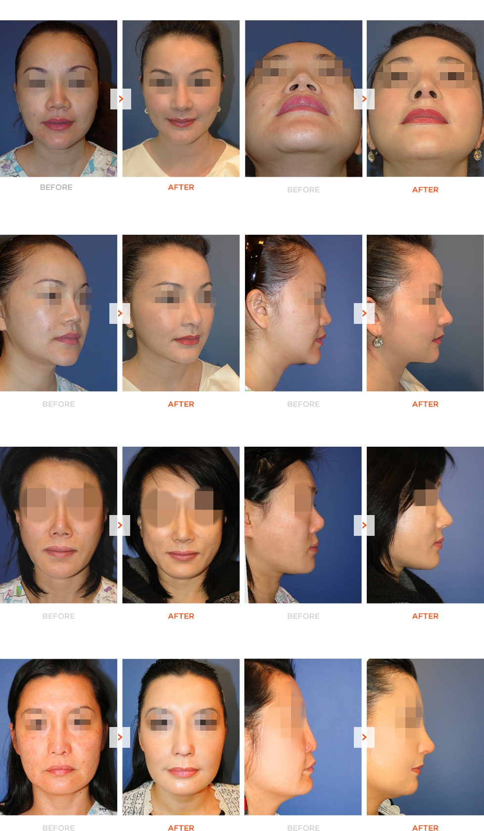 脸部中央提升手术与隆鼻手术前后对比