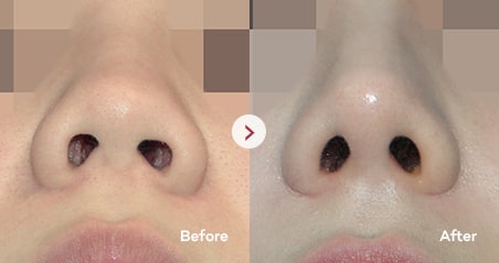 Deviated Nose before and after