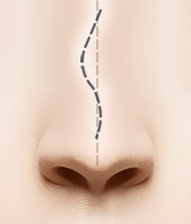 隆鼻术后鼻中隔弯曲