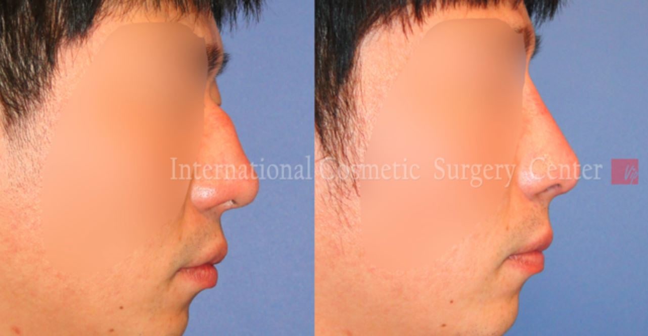隆鼻修复手术前后对比（下垂鼻）