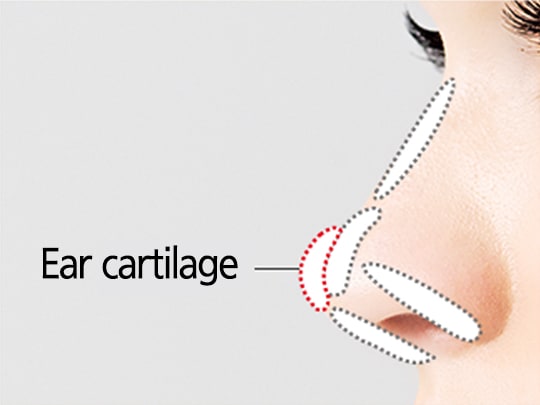 简单鼻部整形的手术方法（耳软骨）